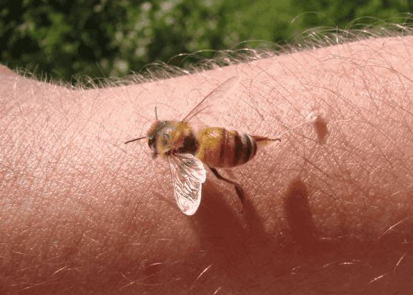 Bee sting